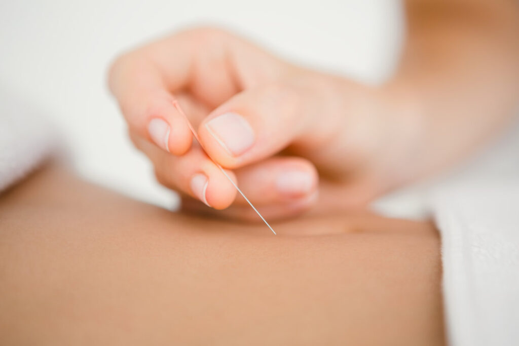 Toronto acupuncture
